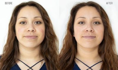 before and after image of HydraFacial 