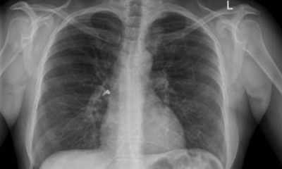 COVID-19 Omicron Variant Causes Less Lung Damage, Study Suggests