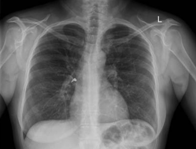 COVID-19 Omicron Variant Causes Less Lung Damage, Study Suggests