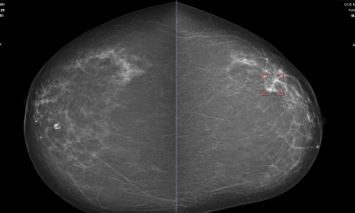 Doctors using AI catch breast cancer more often than either does alone