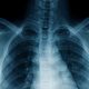An AI used medical notes to teach itself to spot disease on chest x-rays