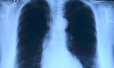 Newly Developed AI Can Predict 10-Year Heart Risk From A Single Chest X-Ray