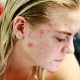 Common Acne Treatment In Adolescents Can Have Long-Term Effects On Skeletal System: Study