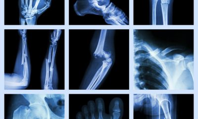 Study Finds This Vitamin Reduces Risk Of Bone Fracture, And It's Not Vitamin D