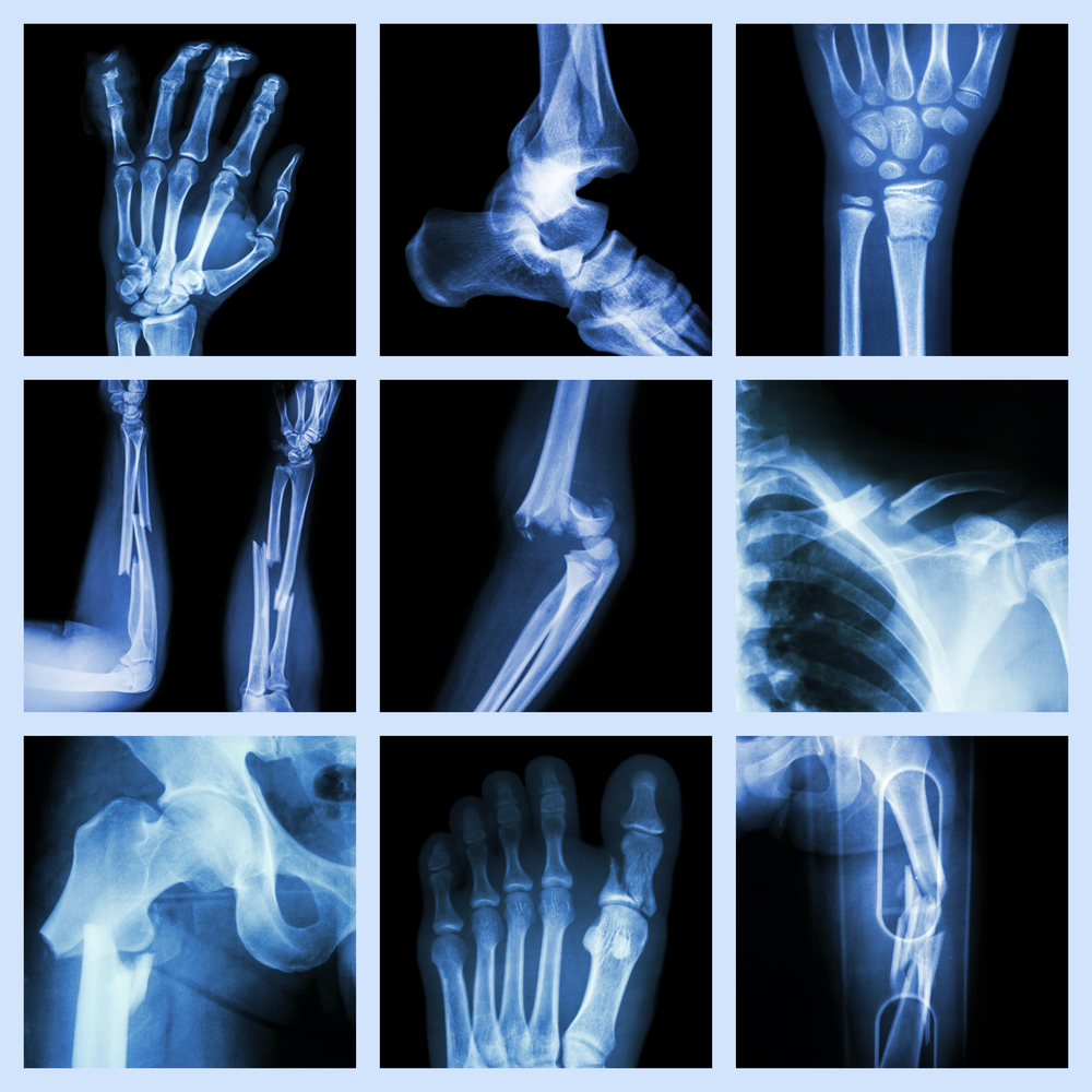 Study Finds This Vitamin Reduces Risk Of Bone Fracture, And It's Not Vitamin D