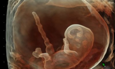 Enzyme Treatment Given To Fetus Prevents Debilitating Condition That Killed Siblings