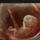 Enzyme Treatment Given To Fetus Prevents Debilitating Condition That Killed Siblings