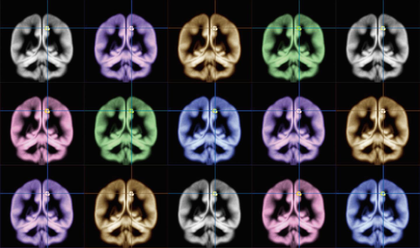 Study Finds Markers Of ADHD In MRI Scans: 'Changes In Almost All Regions Of Brain'