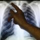 Ashkenazi Jews Susceptible To Rare Genetic Disease That Protects Them From TB: Study