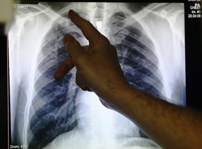 Ashkenazi Jews Susceptible To Rare Genetic Disease That Protects Them From TB: Study