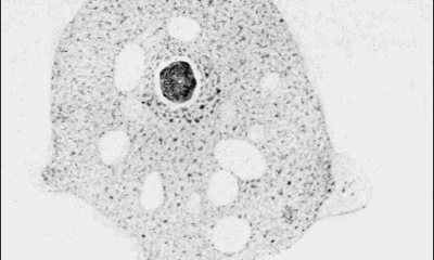 Doctors Save Man Infected By Extremely Rare Brain-Eating Amoeba With Old UTI Drug