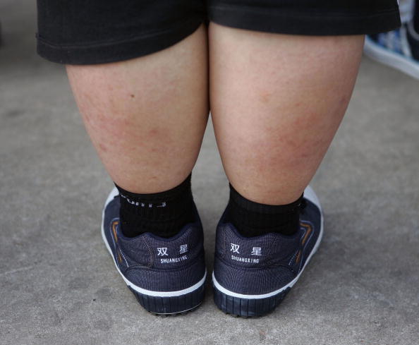 Obesity In Children Linked To Higher Risk Of 4 New Subtypes Of Adult-Onset Diabetes