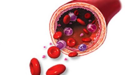 Hemophilia is a blood disorder in which patients do not have enough platelets or clotting factors in their blood.